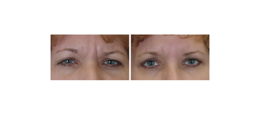 8 Reasons Women Love BOTOX® (Even Men, Too!)