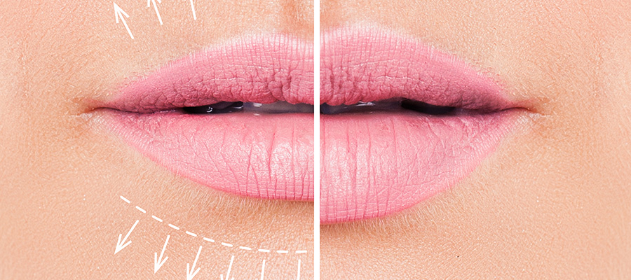 What Type of Filler is Right For You?