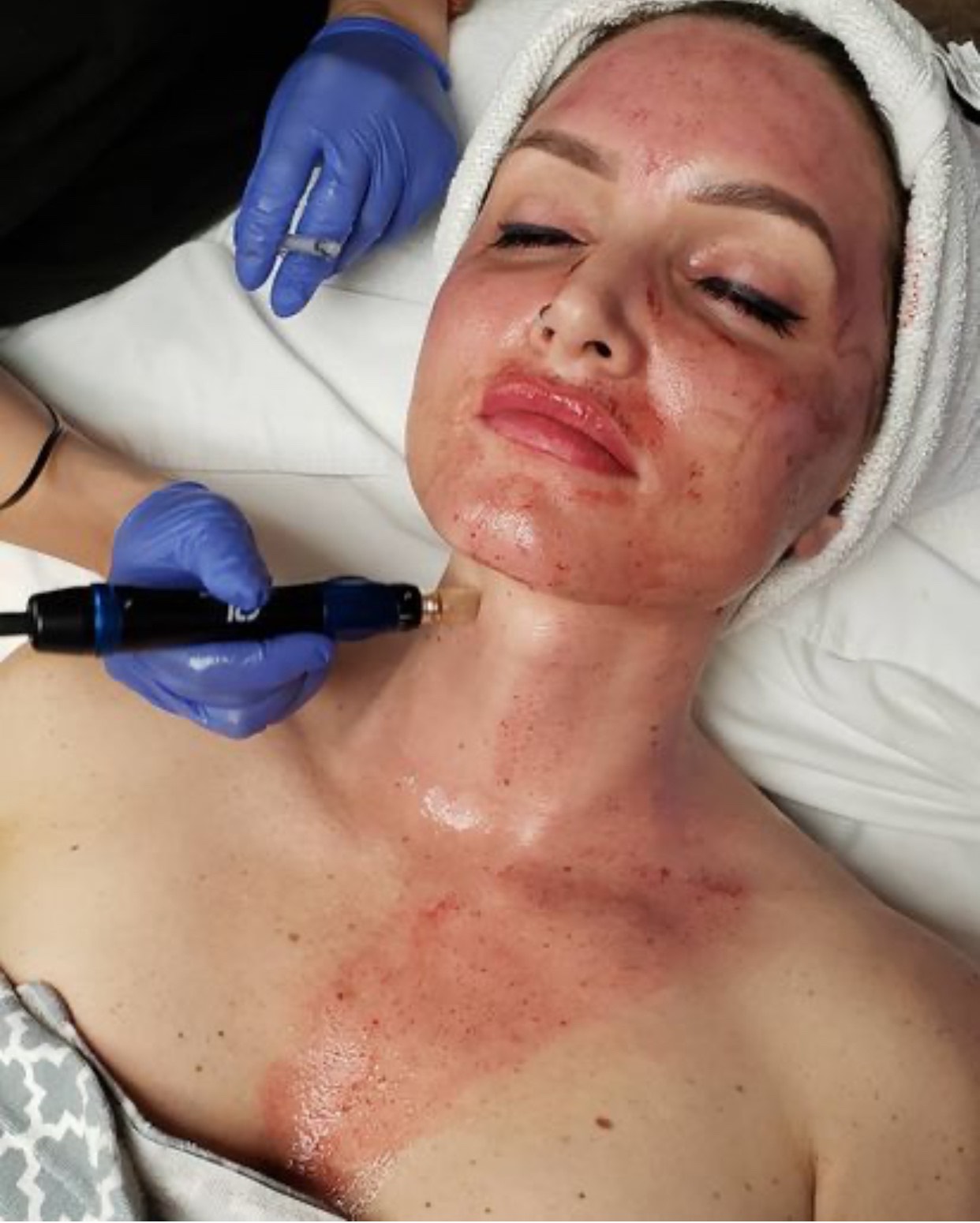 Patient undergoing microneedling treatment