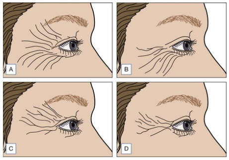 Crow's Feet classification